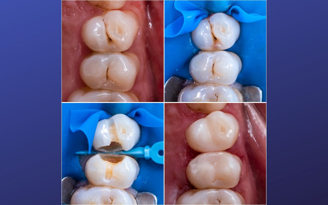 Tooth / Dental Fillings